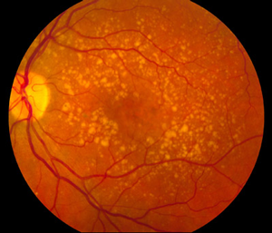 Photo of a retina with dry AMD