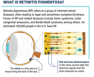 What Is Retinitis Pigmentosa (RP)?