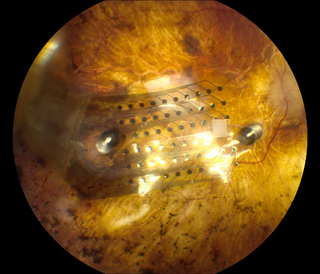 Photo of the Argus II implanted in the Retina