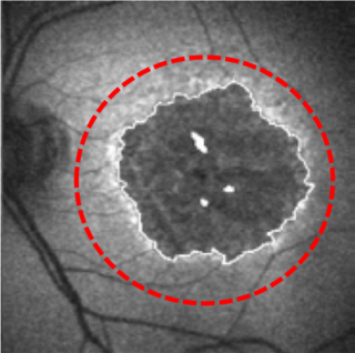 Image of a retina affected by geographic atrophy or GA (dark area). Edge of the GA transition zone marked with red circle.