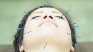 Photo of acupuncture patient with needles sticking out of her face.