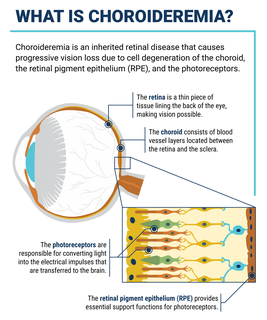 WHAT IS CHOROIDEREMIA? -- Choroideremia is an inherited retinal disease that causes progressive vision loss due to cell degeneration of the choroid, the retinal pigment epithelium (RPE), and the photoreceptors. The retina is a thin piece of tissue lining the back of the eye, making vision possible. The choroid consists of blood vessel layers located between the retina and the sclera. The photoreceptors are responsible for converting light into the electrical impulses that are transferred to the brain. The retinal pigment epithelium (RPE) provides essential support functions for photoreceptors.