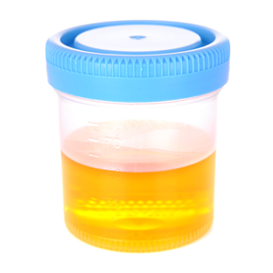 Photo of urine sample in test container